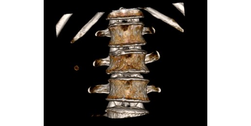 CT-Aufnahme einer Wirbelsäule 