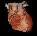 Darstellung der Herzkranzgefaesse