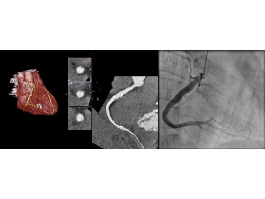 Kardio-CT mit Darstellung der Herzkranzgefäße im Vergleich mit Herzkatheter
