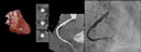 Kardio-CT mit Darstellung der Herzkranzgefäße im Vergleich mit Herzkatheter